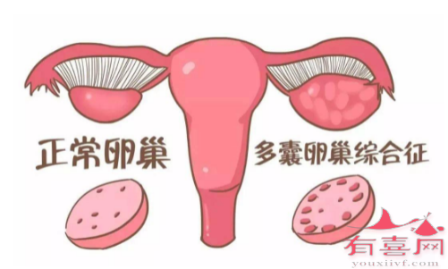 青岛供卵借腹生子：多囊卵巢拖延时间过长会怎样？